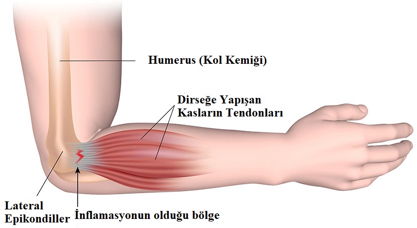 Tenisçi Dirseği